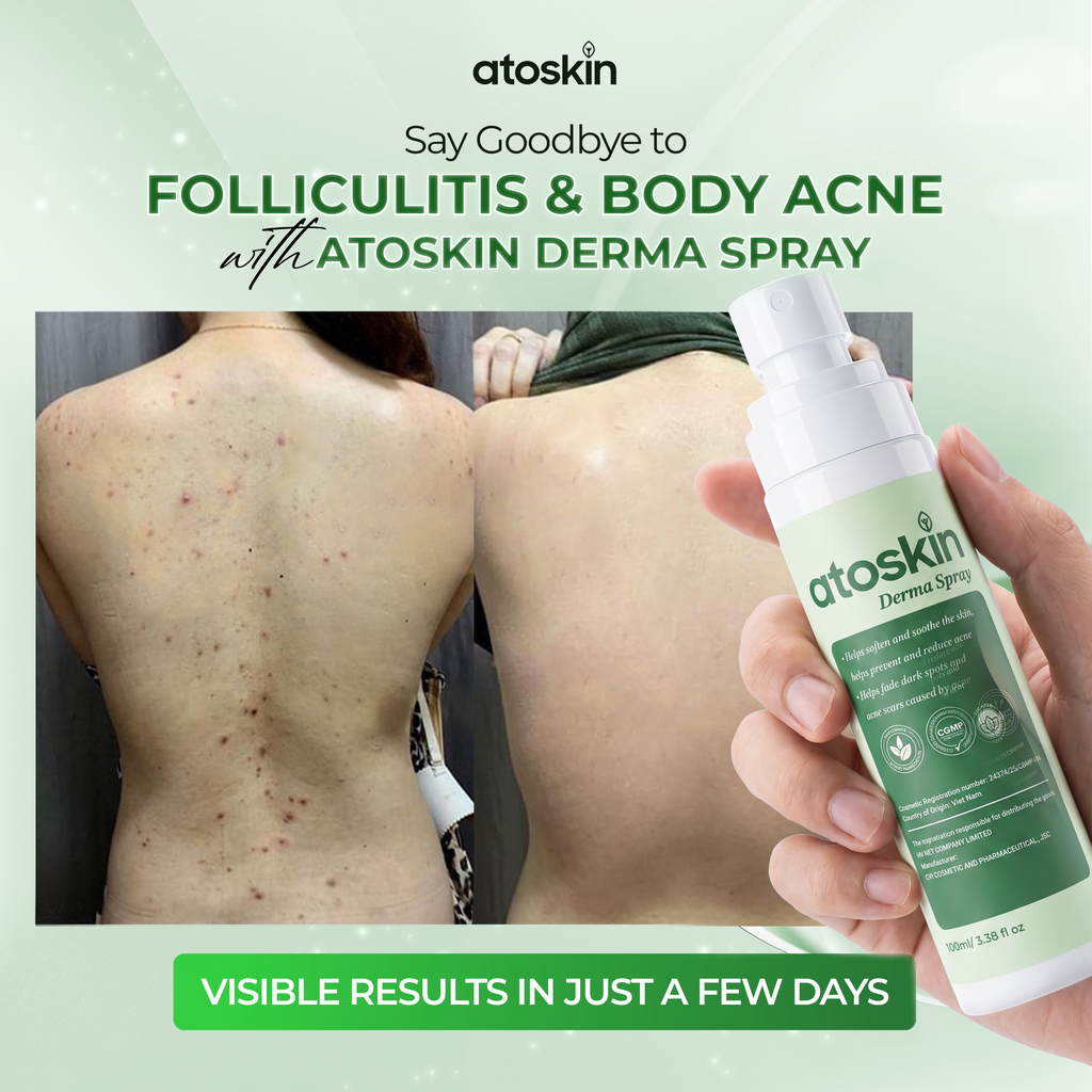 Xịt Mụn Cơ Thể ATOSKIN