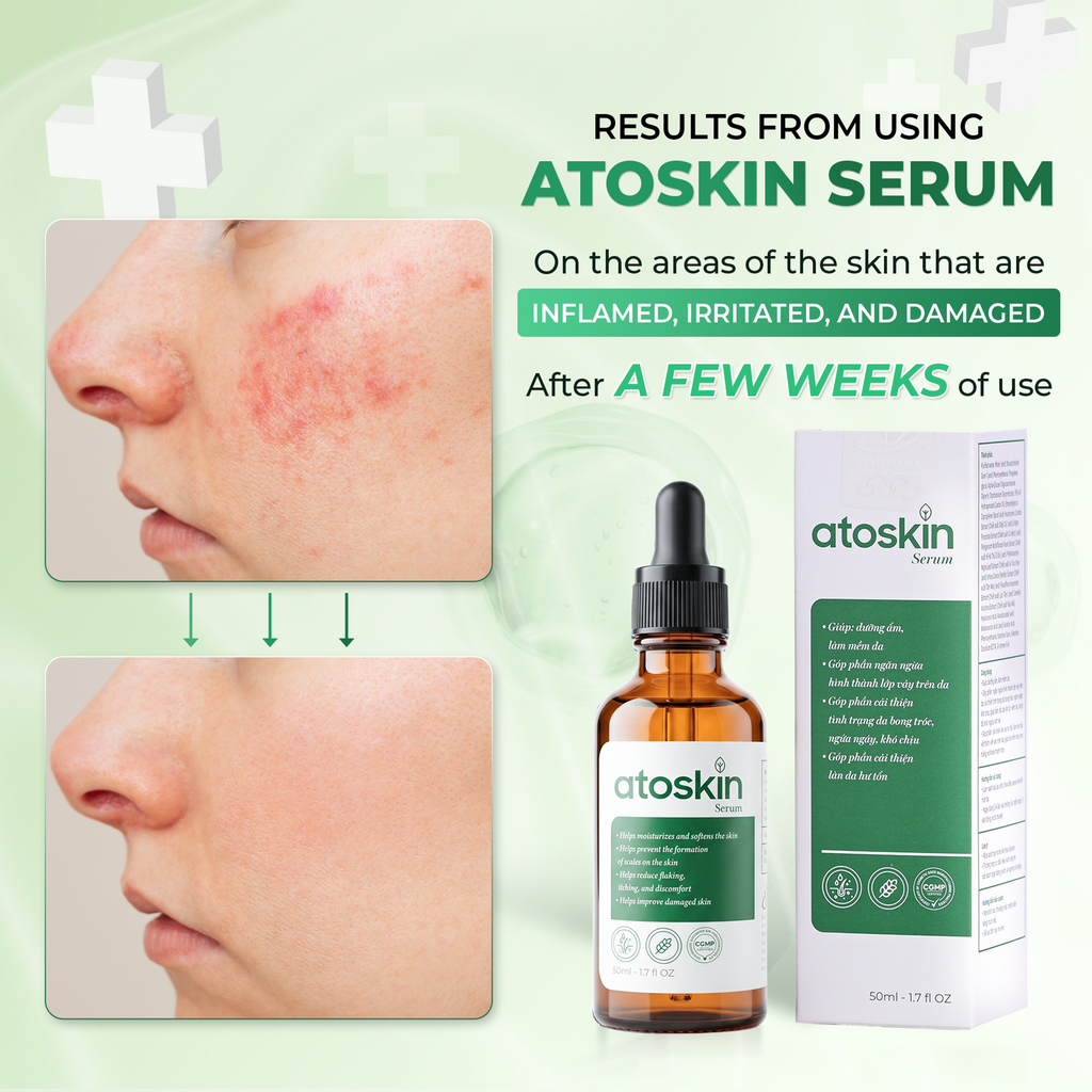 Serum Viêm Da Cơ Địa ATOSKIN 50ml