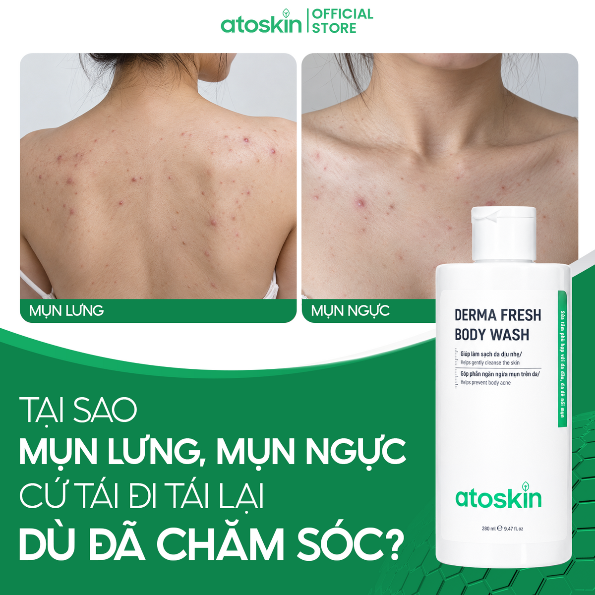 Sữa Tắm Mụn Cơ Thể ATOSKIN Derma Fresh Bóy Wash 280ml