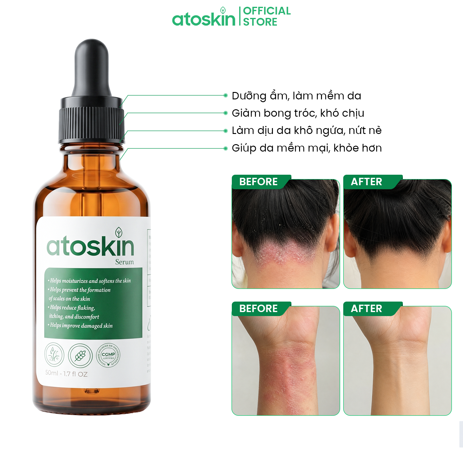 Serum Viêm Da Cơ Địa ATOSKIN Serum 50ml