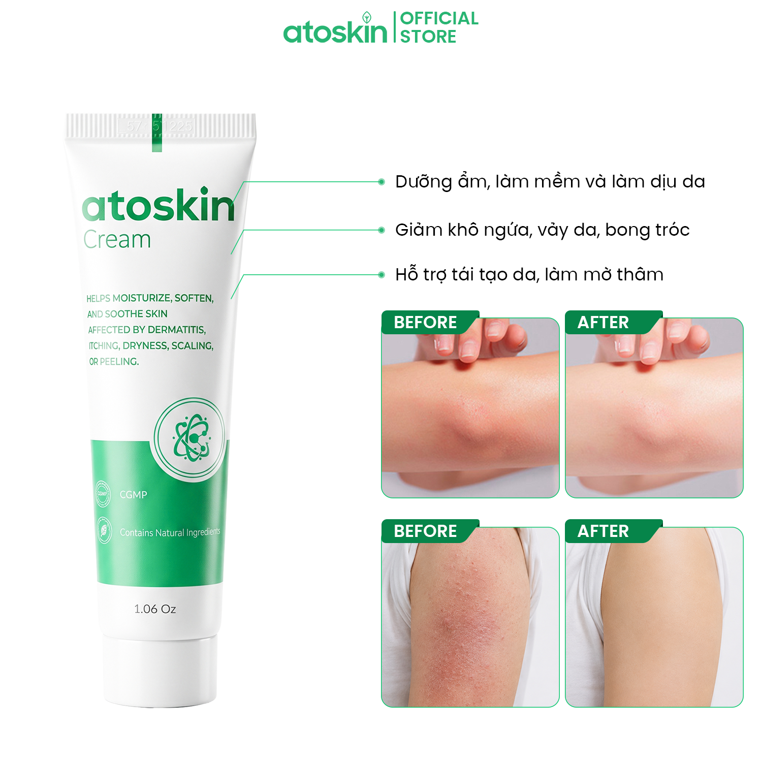 Kem Viêm Da Cơ Địa ATOSKIN Cream 30g