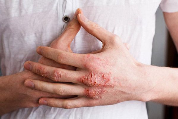bệnh eczema có chữa khỏi được không