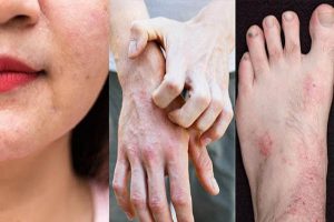 Bệnh viêm da cơ địa có chữa khỏi được không?