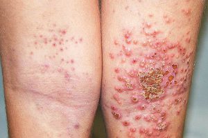 Viêm da cơ địa bội nhiễm là gì?