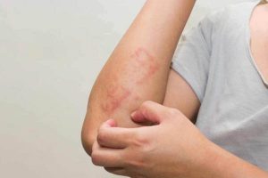 viêm da cơ địa tái đi tái lại