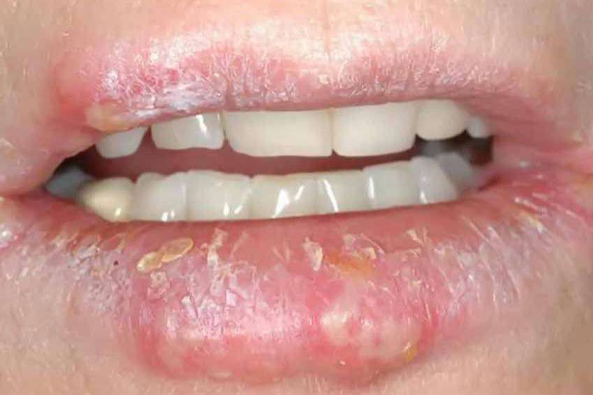triệu chứng bệnh chàm môi