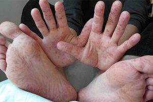 Bị chàm ở chân