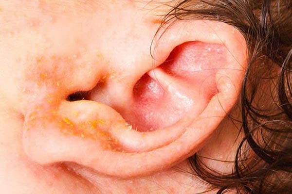 chàm vành tai ở trẻ