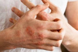 Bệnh tổ đỉa: 5 triệu chứng thường gặp và cách điều trị