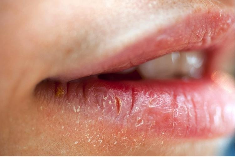 Tình trạng phát ban, bong tróc da khi bị viêm da cơ địa quanh miệng