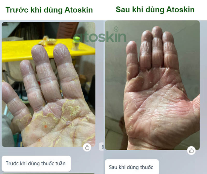Chỉ sau 1 tuần sử dụng Atoskin bàn tay bong vảy của anh Trung - Cần Thơ đã giảm rõ rệt.